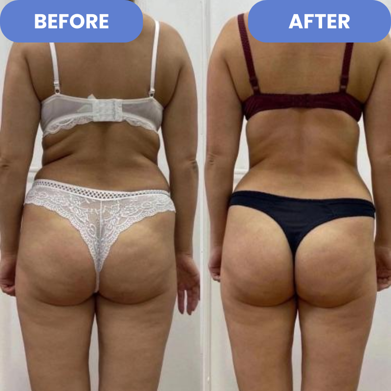 Velina™ - Anti-Cellulite-Entferner | 50 % RABATT