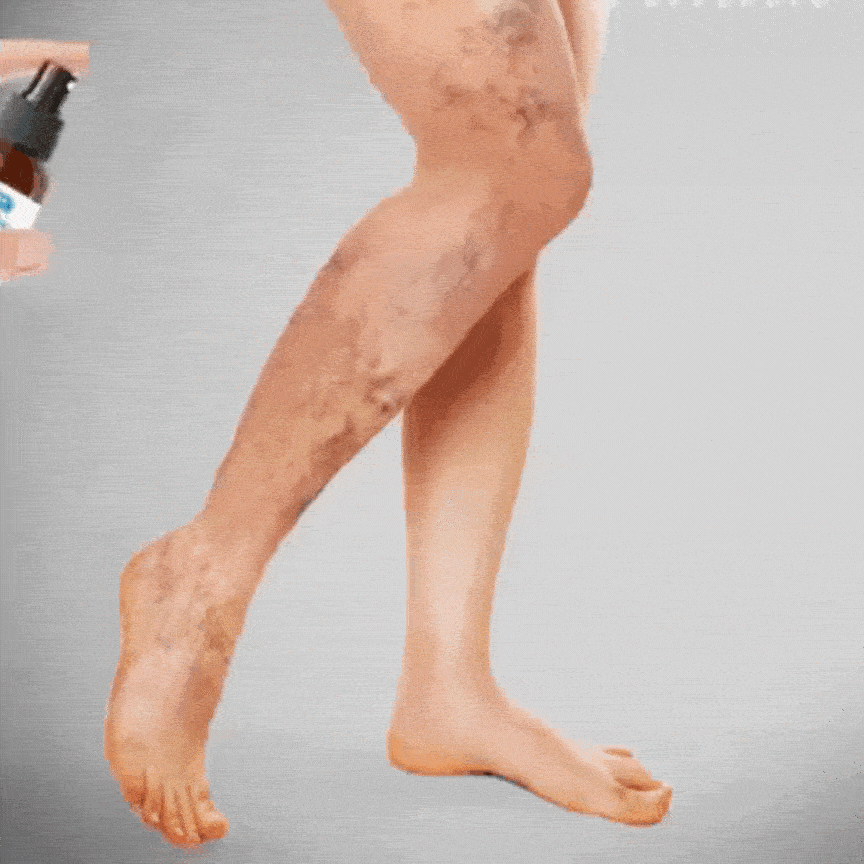 VitaliLeg™ Erleben Sie sofortige Linderung bei Gelenkschmerzen und Krampfadern! 1+1 GRATIS